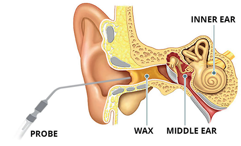 Ear microsuction