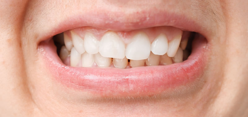Bruxism treatment